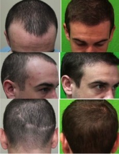 Abu Dhabi Hair Restoration: Photos & Videos